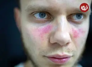 درباره لوپوس و سایر بیماری‌های خودایمنی