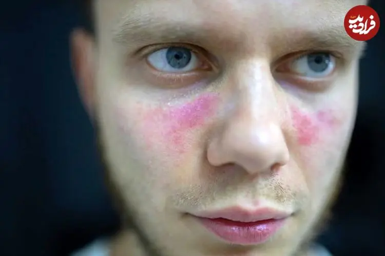 درباره لوپوس و سایر بیماری‌های خودایمنی