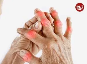 ۱۲ خوراکی که التهاب بدن را بیشتر می‌کند؛ چه رژیمی برای مفاصل مناسب‌تر است؟