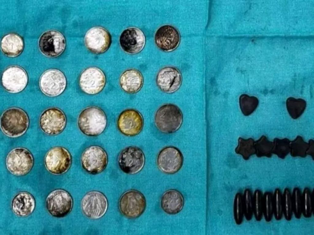 پیدا شدن ۳۹ سکه و ۲۷ آهنربا در روده مردی که برای عضله سازی خورده بود!
