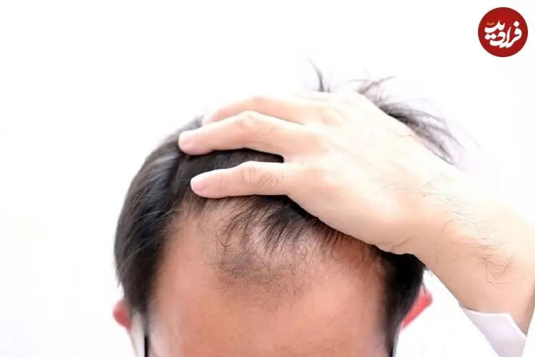 دلایل شایع ریزش مو