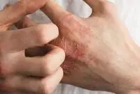 ( عکس) این دانش‌آموز ۱۴ ساله مخترع صابونی برای درمان سرطان پوست