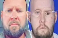 ( ویدیو) اولین پیوند موفقیت آمیز چشم کامل در جهان انجام شد 