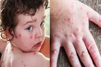 از بیماری نادر «آنفلوانزای گوجه‌فرنگی» چه می‌دانید؟!