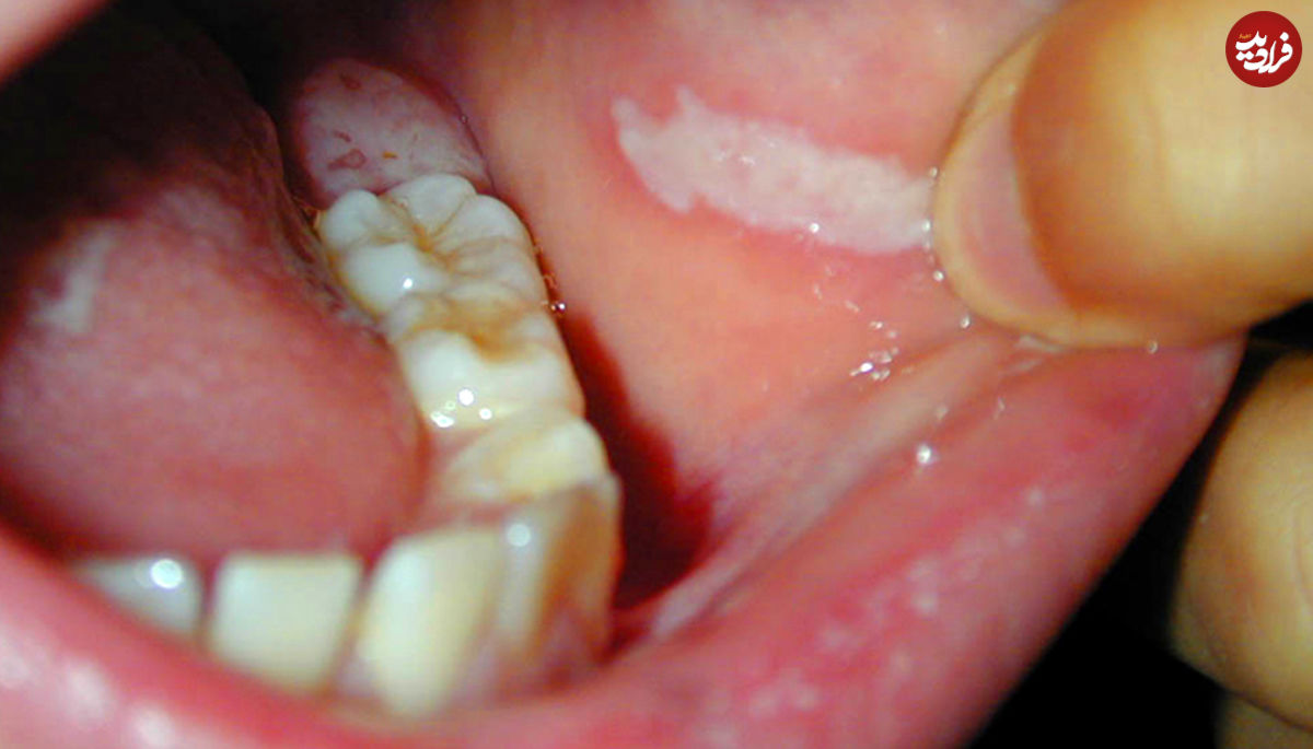 نشانه‌های سرطان روی زبان!
