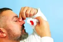 چطور خون‌دماغ را بند بیاوریم؟ | راه‌های پیشگیری از خون‌دماغ شدن