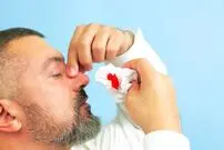 چطور خون‌دماغ را بند بیاوریم؟ | راه‌های پیشگیری از خون‌دماغ شدن