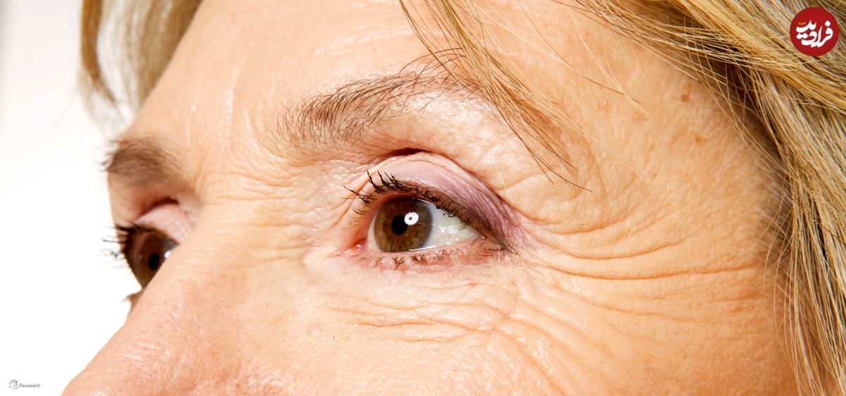درمان چروک دور چشم با ترکیب ساده یک میوه و دارویی دَم دستی