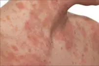 اگزما از طریق لمس منتقل می‌شود؟!