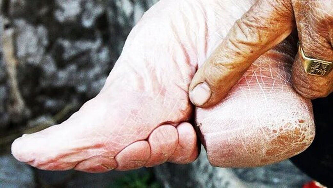 (عکس) شکستن استخوان‌های پا برای زیبایی؛ دردناک‌ترین سنت جهان!