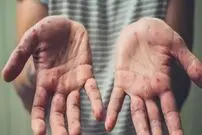 اینفوگرافیک/ نکاتی که باید درباره آبله میمون بدانید