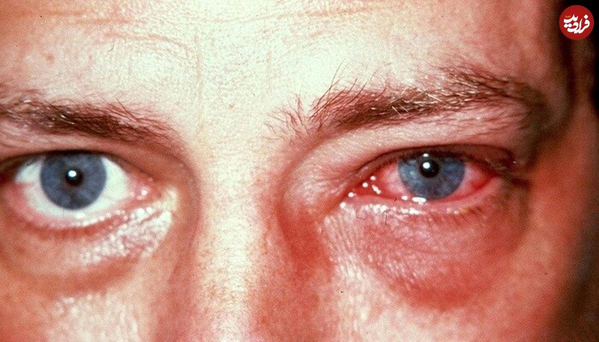 ۶ عفونت چشمی خطرناک