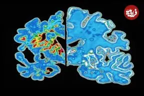 دانشمندان «ساعت آلزایمر» ساختند!