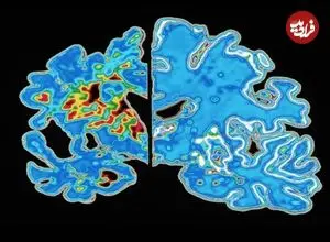 دانشمندان «ساعت آلزایمر» ساختند!
