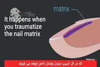 ویدیو/ لکه‌های سفید روی ناخن؛ باورهای غلط و حقایق