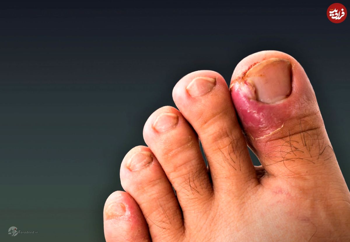 علت فرو رفتن ناخن در انگشت پا چیست؟