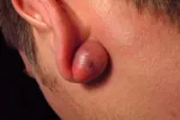 پیرسینگ پارتی؛ از التهاب و تورم تا خفگی