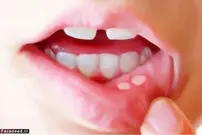 درمان خانگی برای آفت دهان