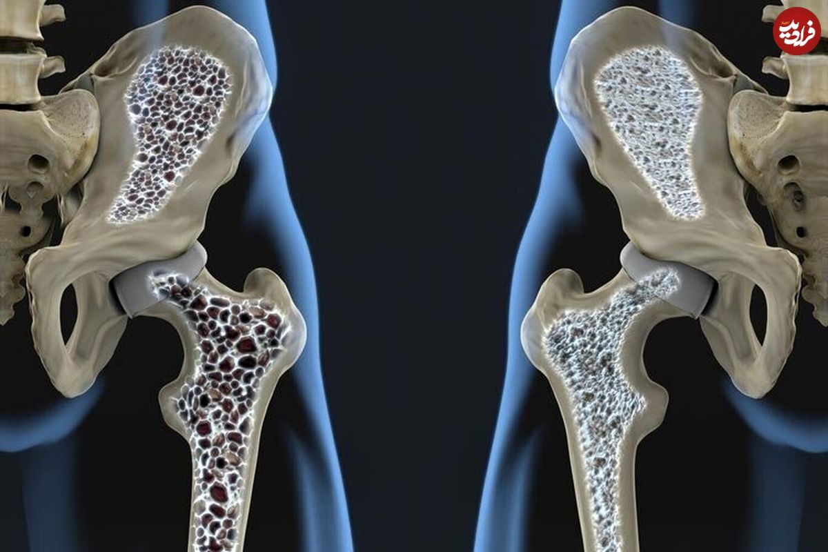 موثرترین راه پیشگیری از پوکی استخوان