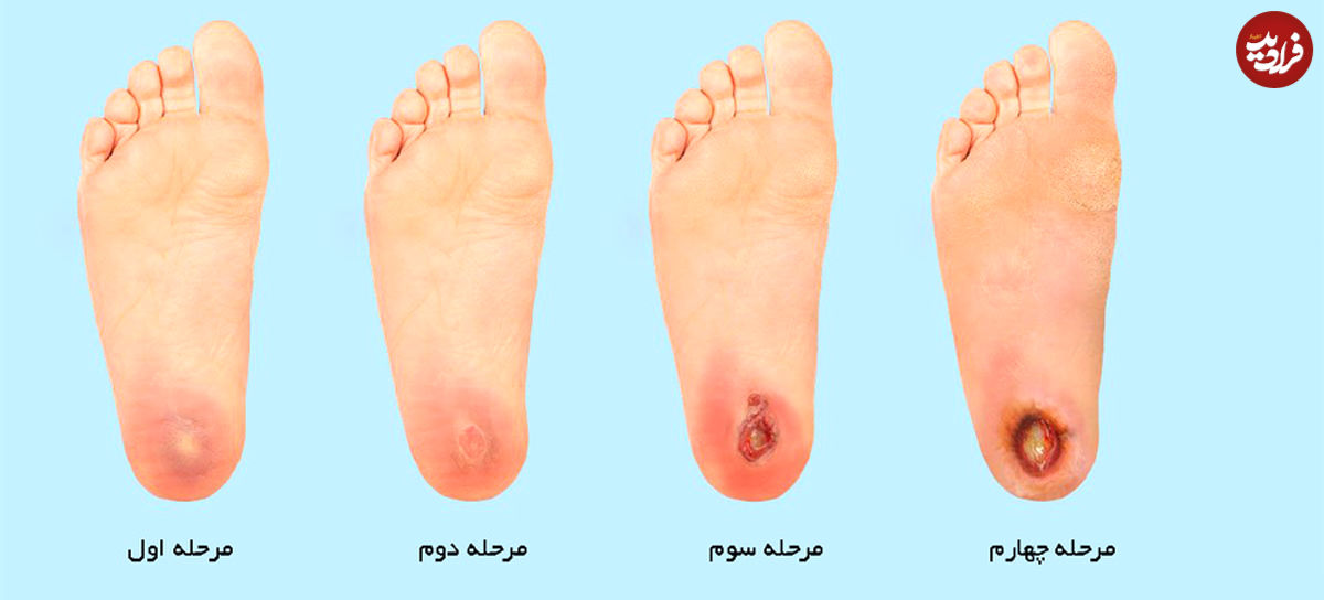زخم دیابت و روشهای درمان