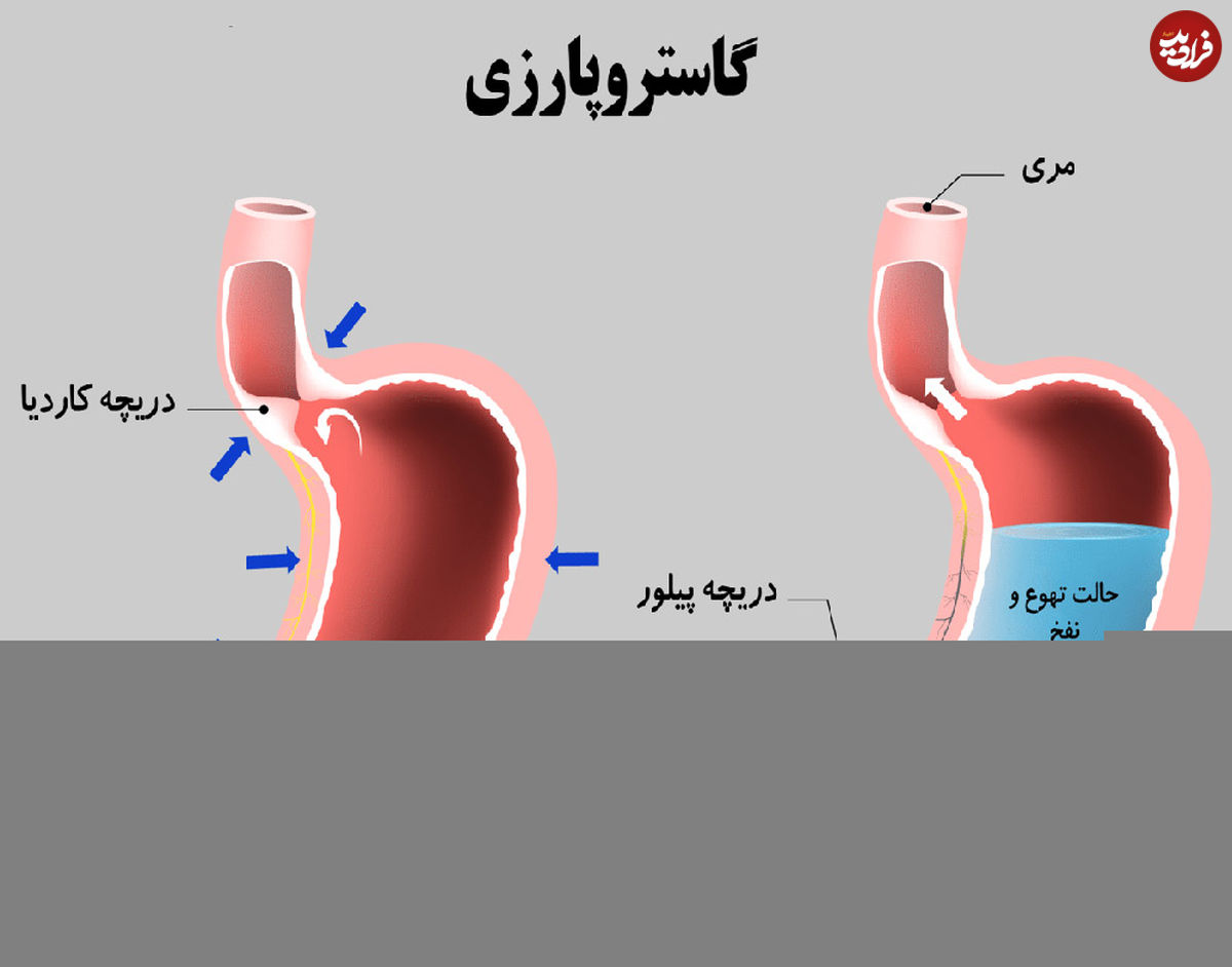 وقتی معده فلج میشود؛ از علائم تا درمان