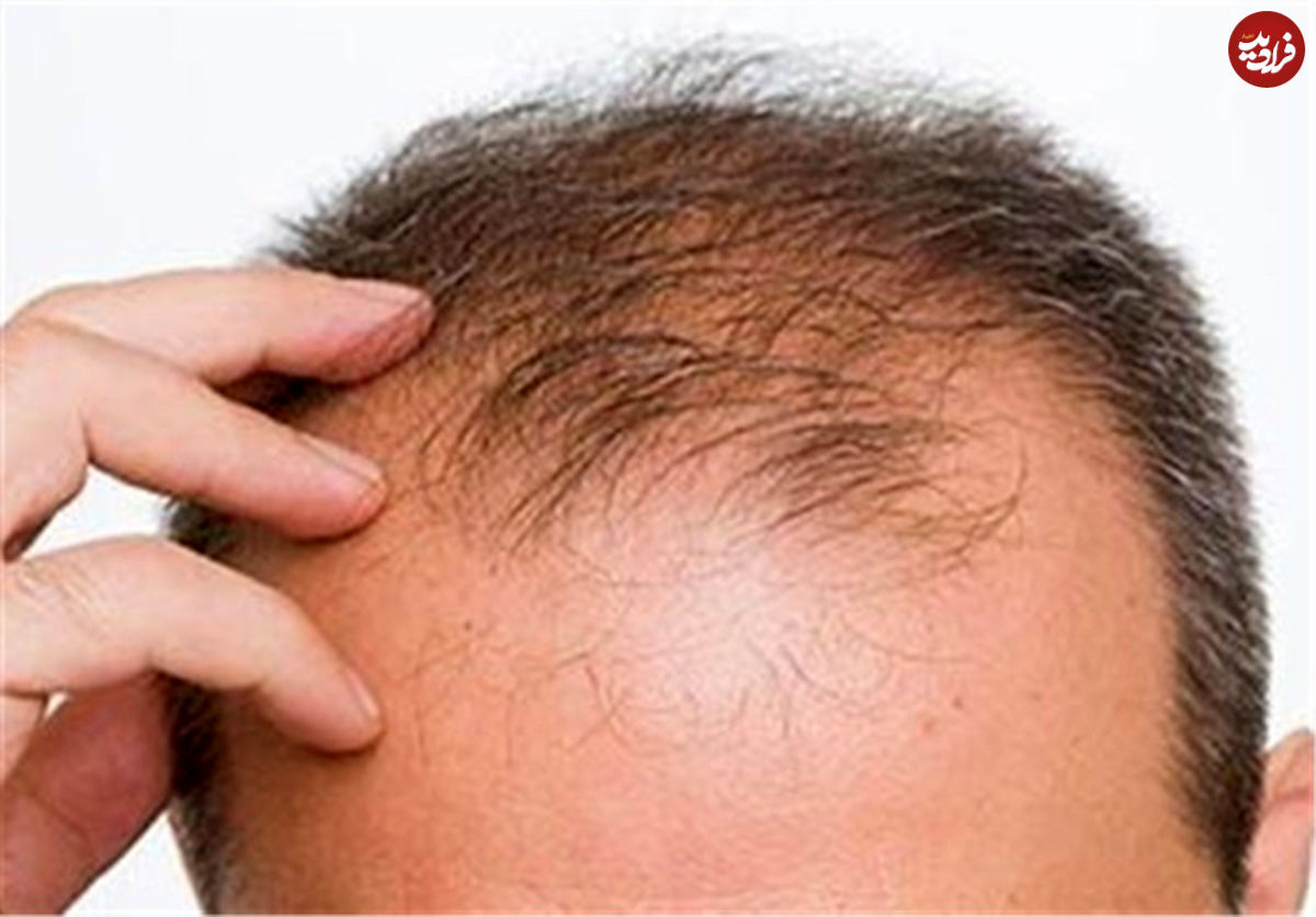 شیوه جدید درمان ریزش مو