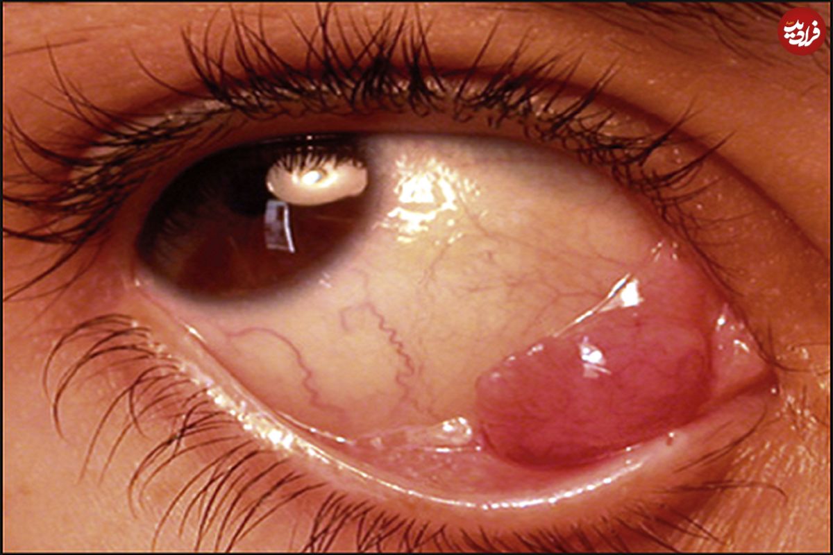 لنفوم (سرطان) چشم؛ از علائم تا درمان