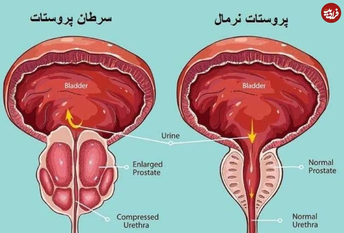 علائم زودهنگام سرطان پروستات