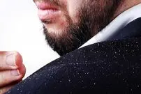 روش‌های خانگی درمان شوره سر