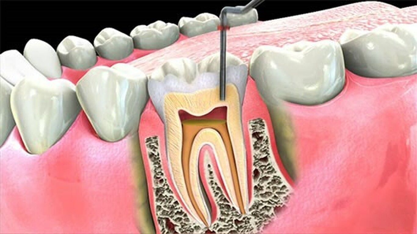 (ویدئو) عصب‌کشی دندان چگونه است؟