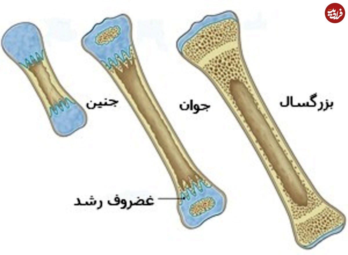 اینفوگرافی؛ عمر کوتاه استخوانهای ایرانی