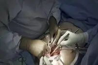 پیوند عجیب کلیه خوک به انسان انجام شد 