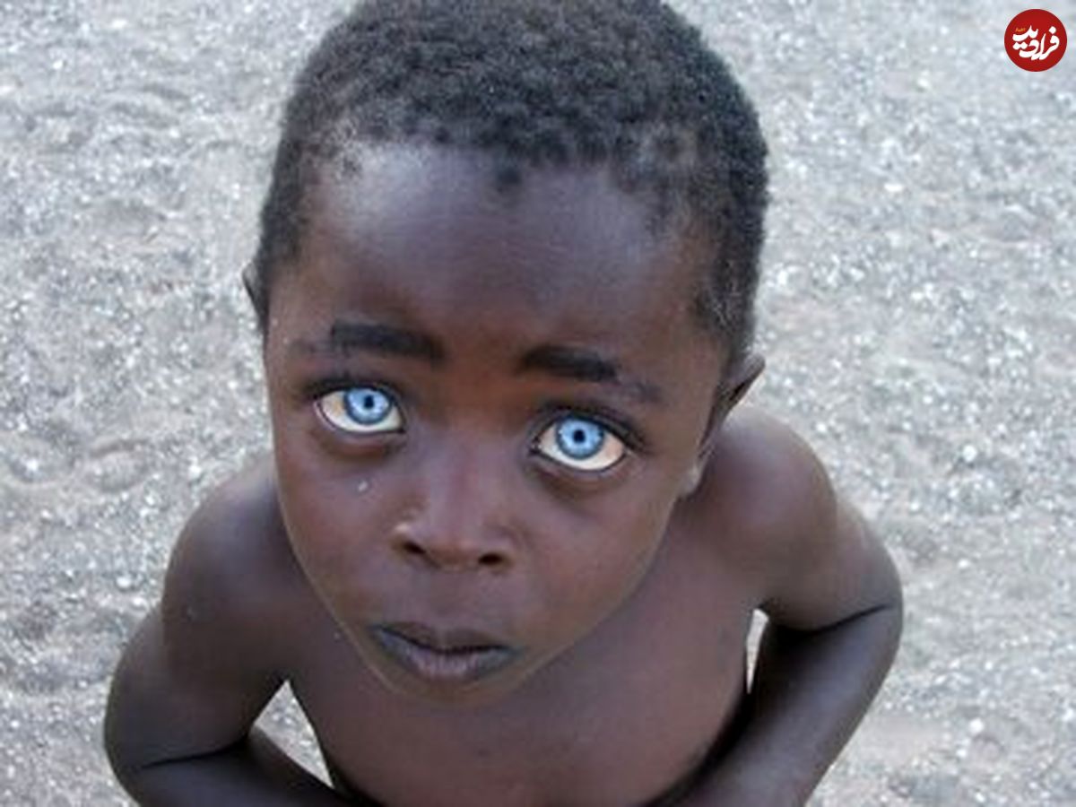 (عکس) نادرترین رنگ چشم در میان انسان‌ها