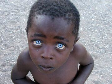 (عکس) نادرترین رنگ چشم در میان انسان‌ها