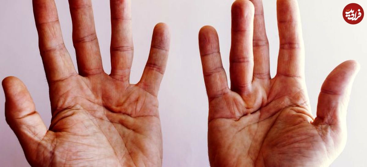 از بیماری "کف دست" چه می‌دانید؟