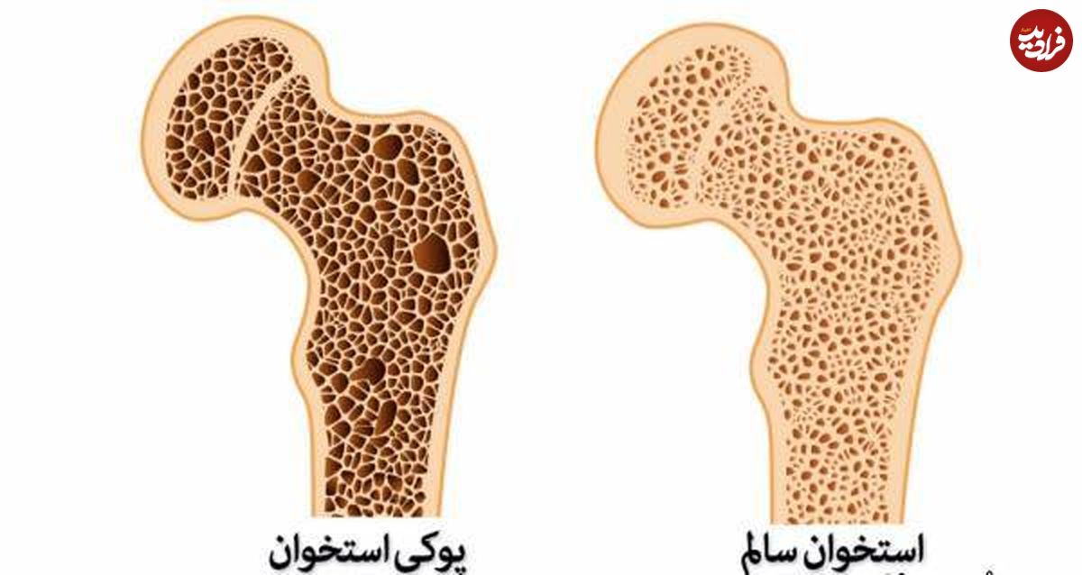 پوکی استخوان بیماری خاموش