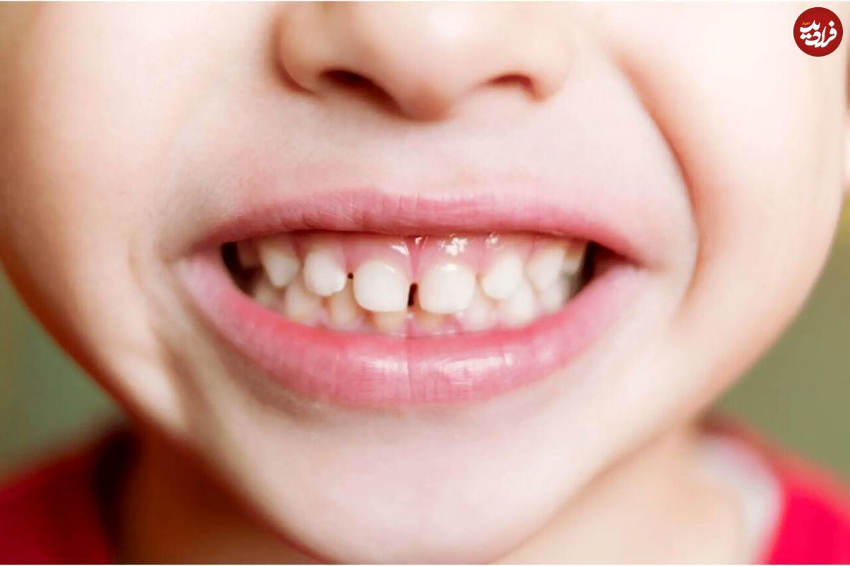 فهرست دارو‌هایی که باعث نقص مینای دندان کودکان می‌شوند
