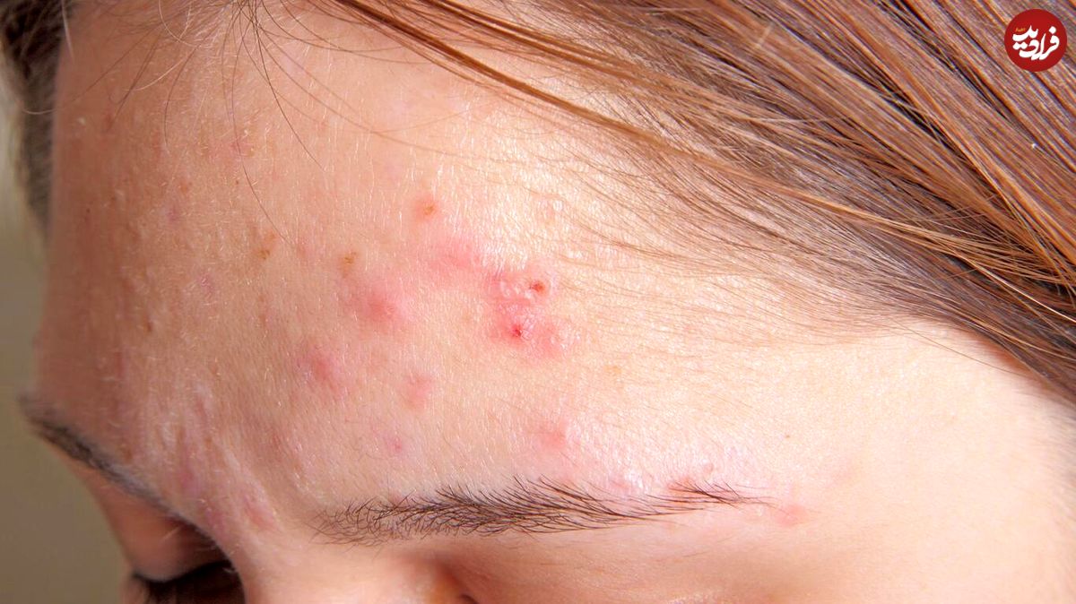 آیا شستشوی بیش از حد صورت دلیل بروز آکنه است؟