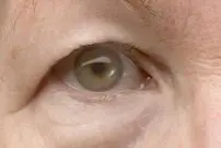 ۱۵ دلیل برای افتادگی پلک چشم