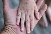 مرگ بیش از ۲۰۰ هزار نفر بر اثر سرخک