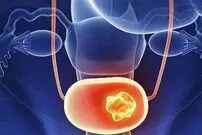 دلایل ابتلا به سنگ مثانه را بشناسید