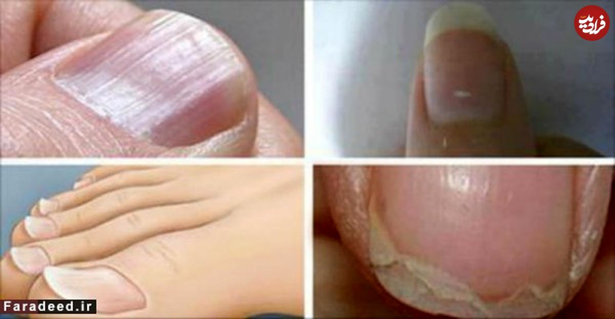 علائم هشداردهنده ناخن را جدی بگیرید