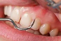 چه عواملی باعث تغییر شکل لثه‌ها می‌شود؟