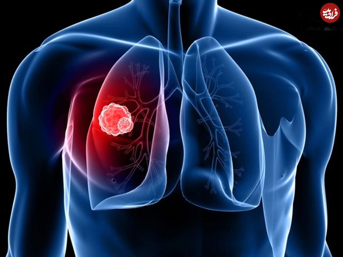 تنگی نفس یکی از مهمترین علائم آمبولی ریه