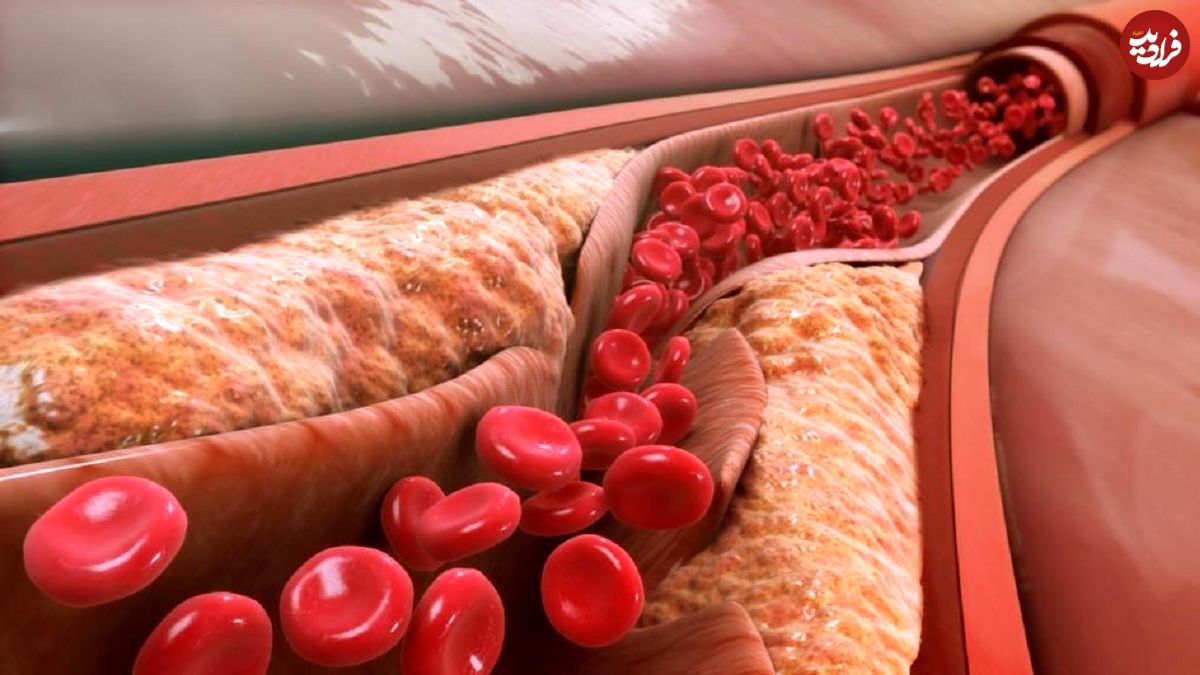 کلسترول و تری گلیسیرید چه فرقی با هم دارند؟