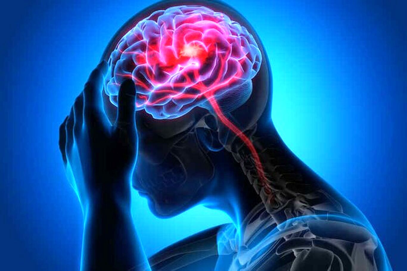 علائم اصلی سکته مغزی چیست و میگرن در این بیماری چه تاثیری دارد؟