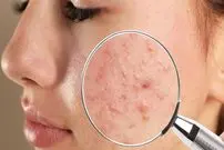 با جای جوش‌ها چه کنیم؟