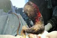 خارج کردن توده «مو» از معده دختر 14 ساله