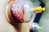 این افراد به هیچ وجه نباید حجامت کنند