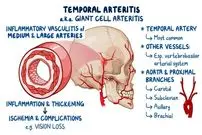 چرا سردرد شقیقه پس از ۵۰ سالگی همیشه باید جدی گرفته شود؟